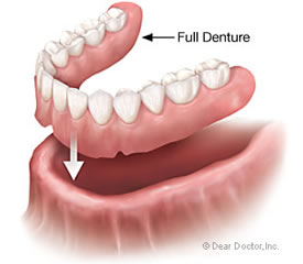 dentures3