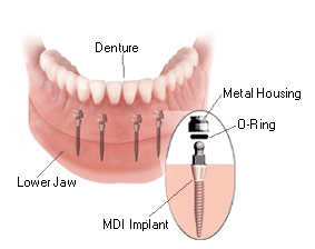 MDI Denture Stabilization