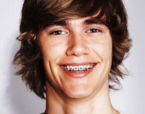 braces1