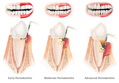 gumdisease2